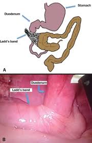 Image result for Intestinal Malrotation