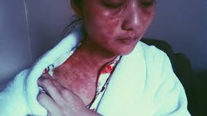 Help ITSAN: raising awareness for Red Skin Syndrome