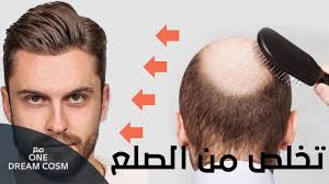 لن تصدق كيف تخلص من الصلع و اصبح لديه شعر Hair Extension Youtube