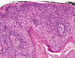 Prostate cancer is a common type of cancer in men, according to the mayo clinic. Squamous Cell Skin Cancer Wikipedia