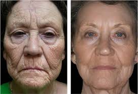 She is 8 months after co2 laser in this before and after photo. Acupulse Co2 Laser By Lumenis Spa Cielo Cabo