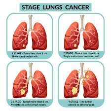 Cancer is a large group of diseases that can start in almost any organ or tissue of the body when abnormal cells grow uncontrollably, go beyond their usual boundaries to invade adjoining parts of the body and/or spread to other organs. Lung Cancer Symptoms Causes Treatment Narayana Health