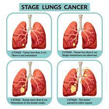 People often associate lung cancer with breathing problems like coughing, shortness of breath, or wheezing. Lung Cancer Symptoms Causes Treatment Narayana Health