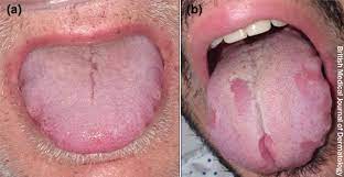3 730 568 просмотров • 18 нояб. Covid Tongue May Be A Symptom Professor Says