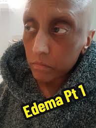 Experiencing Edema: A Personal Journey