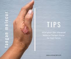 Terkena air panas dan luka bakar : Tips Hilangkan Dan Merawat Melecur Tangan Kena Air Sup Panas Umi Nazrah