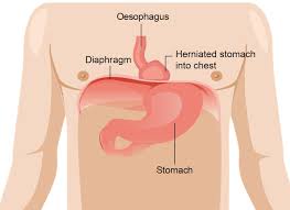 Image result for stomach hernia symptoms