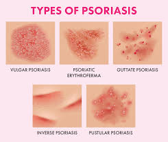 These can burn, itch, or feel sore. Beautiful Mind Health Care 7760420485 Skin Clinic In Bangalore Skin Doctor In Bangalore Dermatologist In Bangalore Skin Specialist In Bangalore Cosmetology Clinic In Bangalore Best Skin Clinic In Bangalore Best