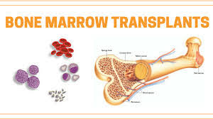 We did not find results for: Bone Marrow Transplant Is A Way Of Giving Very High Dose Chemotherapy Sometimes With Whole Body Radiotherapy This Treatment Aims To Try To Cure Some Types Of Blood Cancer Such As Leukaemia