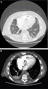 Image result for Atelectasis