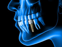 Dental Implants on the Rise