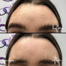 We are the leaders in laser hair removal for men and women. Prolase Laser Clinic 90 Photos 518 Reviews Laser Hair Removal 15030 Ventura Blvd Sherman Oaks Ca Phone Number