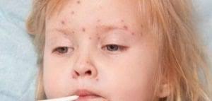 ما هى اعراض مرض الايدز وطرق العلاج