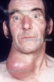 Image result for Goiter