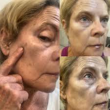 Fast Dark Spot Remover