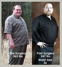 In many cases, blood glucose levels fall short after the operation. Before After Pictures Testimonials Gastric Bypass Before After Testimonials After Obesity Surgery San Francisco California