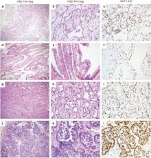 However, larger psammomatous bodies that cause symptoms. Genomic Profiling Of Malignant Peritoneal Mesothelioma Reveals Recurrent Alterations In Epigenetic Regulatory Genes Bap1 Setd2 And Ddx3x Modern Pathology