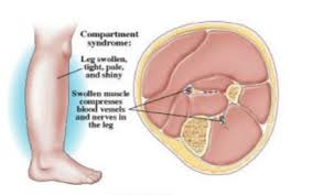 Image result for Compartment Syndrome