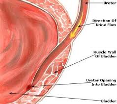 Urinary Tract Infections Uti Do Not Always Cause Visible Signs And Symptoms But In Most Cases You Would Health Heal Herbal Remedies Urinary Tract Infection