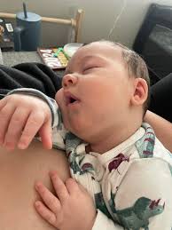 Does this look like a milk allergy? I have an appointment