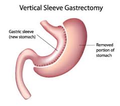 gastric sleeve surgery ui health