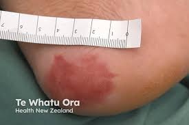 Image result for Skin Ulcer