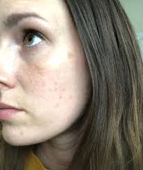 We did not find results for: Skin Concerns Help With My Sun Spots My Otc Regimen Isn T Helping Added To Comments I M Considering Trying A Hydroquinone Treatment Like Musely Or A Laser Treatment But I Have No Idea