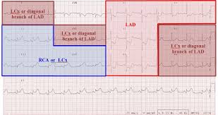 Ecg Leads Vaguely Correspond To Areas Of The Myocardium Supplied By The Coronary Arteries Cardiac Nursing Coronary Arteries Arteries Anatomy