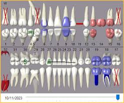 Addressing Multiple Supernumerary Teeth - Dimensions Of Dental Hygiene