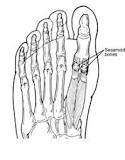 Image result for icd 10 code for sesamoid fracture