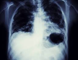 The good news is many cases of lung cancer are believed to be preventable, as an estimated 90% of lung cancer cases are caused by active smoki. Lung Cancer Client Asbestos Diseases Case Thompsons Solicitors
