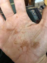 I don't think i'd be contacting a doctor at this stage but wait and see. Rust Colored Splotches On Hands Babycenter