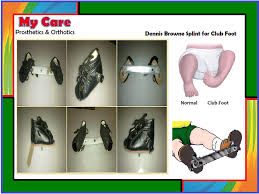 Гена букин кончает в дашу при всей семье (сез1:эп9). My Care Prosthetics And Orthotics On Twitter Dennis Browne Splint For Clubfoot Ctev Ctev Splint Manufacturers In Hyderabad Orthopedic Braces And Splints In Hyderabad Ctev Shoe Shoe With Bar Support Mycaremedical Clubfoot