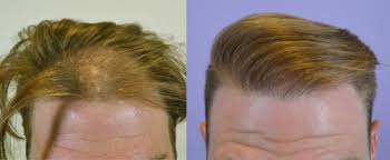 Te is a form of. Case Study Archives Page 2 Of 8 Hair Restoration Of The South