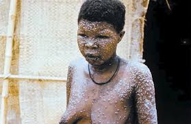 Image result for PICTURE OF MONKEYPOX