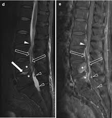 Image result for Spinal Infection
