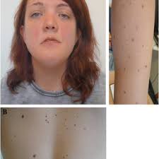 Photograph of the index patient affected by NS with a mutation in NRAS,... 