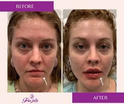 💉💋Discover the difference: From subtle to stunning with our lip  enhancement results. See the before and after transformation!💋💉 Save &  share this post for Lippie inspo✨ #Tresjoliemedicalspa #Anti-Aging  #Lipfiller ...
