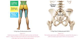 Trigger points in the quadratus lumborum (ql) are notorious for pain in the lower back, top of the hip, and buttocks that often extends down into the upper thigh. Upper Buttock Pain Sacro Illiac Joint Area Pain