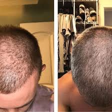 Occasionally alopecia x may also. Hims Reviews Hims