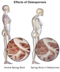Learn about the questions you should be asking about treatment. Osteoporosis What Is It Symptoms Causes Prevention And Treatment Top Doctors