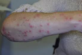 Image result for Papular urticaria