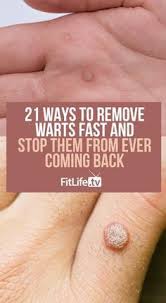 Start Using Natural Wart Remedies To Treat Fingers And Toes These 21 Natural Treatments Are A Fast And Cheap Way To R Natural Wart Remedies Warts Warts Remedy