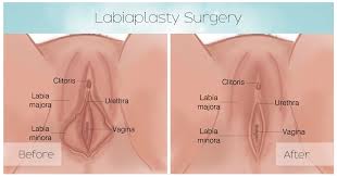 Ingrown hair or pimple turned into a lump!? Labiaplasty Buffalo Ny Niagara Falls Labiaplasty