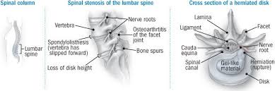 People with a herniated disk do not usually need surgery. Herniated Disk Guide Causes Symptoms And Treatment Options