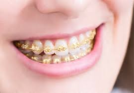 Kalau tak, hadap lah ketidakselesaan tu ye. Bahaya Fake Braces Boleh Tanggalkan Gigi Anda Deenamik