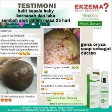 Petua merawat ekzema secara tradisional. Krim Gatal Kulit Ekzema Kudis Renoskin Medic Serum Eczema Sensitive Skin Kulit Sensitif Ubat Gatal Psoriasis Rashes Shopee Malaysia