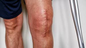 Image result for gout symptoms knee
