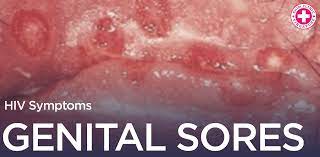 HIV Genital Sores Singapore | HIV Genital Sores | Shim Clinic