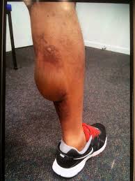 First degree ice pack burn pictures. Post Sports Injury Burn Due To Inappropriate Use Of Cryotherapy Journal Of Urgent Care Medicine